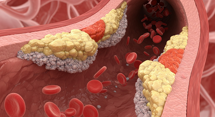 Нарушение липидного обмена. Клинические рекомендации