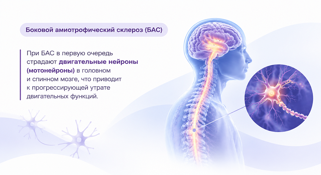 Клинический случай: боковой амиотрофический склероз с выраженным астеническим синдромом.