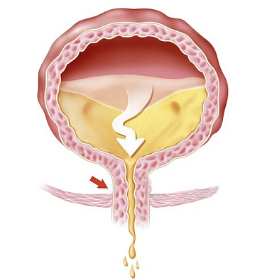 Пациент с ХЗМ - не допустим проблем! 